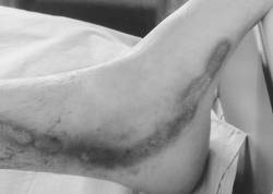 Fig. 4Arborescent second-degree burn on foot; no exit point.