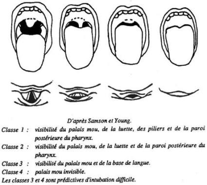 Fig. 4Exposition de la glotte en laryngoscopie directe, en fonction de la visibilit� des structures pharyng�es.