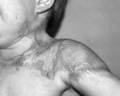 Fig. 13aThirty-month-old child after operative treatment for hot liquid burn in the areas of neck, breast, and shoulder.