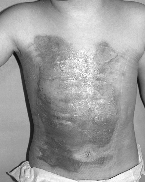 Fig. 14aHypertrophic scars on 3-yr-old child after operative treatment in the breast and abdomen.
