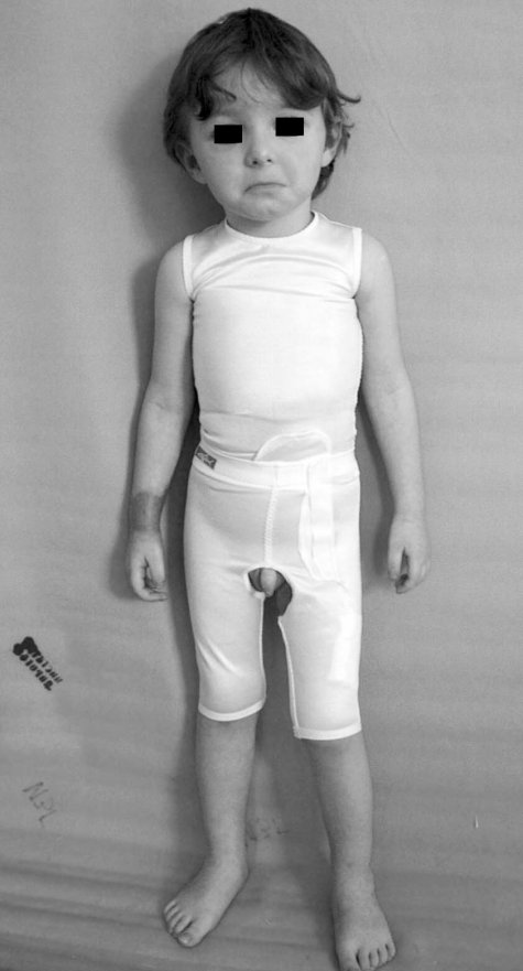 Fig. 14bCompressive therapy.