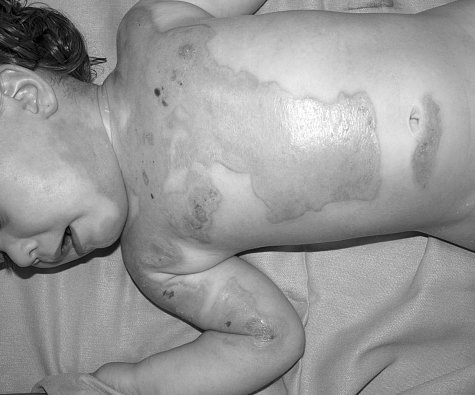 Fig. 15aTwenty-four-month-old child after scalding.