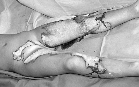 Fig. 16aFour-yr-old child after scalding in abdomen and lower extremities.