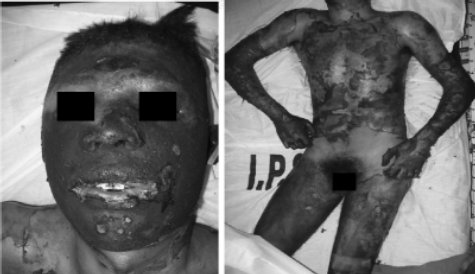 Fig. 5Patients burned in the fire.