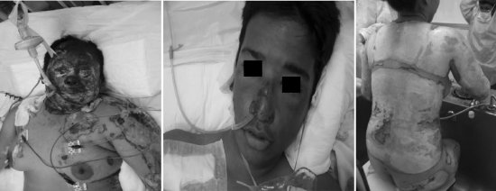 Fig. 7Three more patients.Fig. 8 - Plastic Surgery, Reconstruction, and Burns Service (Instituto de Previsi�n Social).