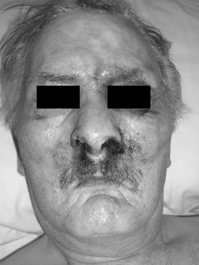 Fig. 1Facial flash burn.