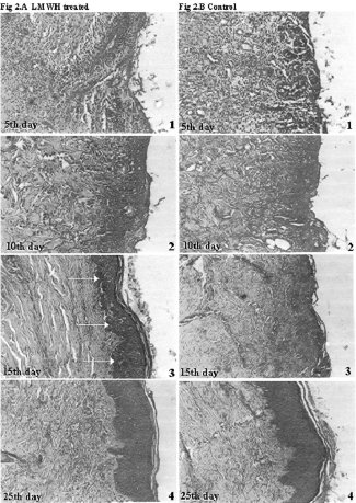 Fig. 2a,bHistological sections represents healing pattern observed in LMWH-treated and control patients. Arrow in day 15 photograph of LMWH-treated group indicates margin of re-epithelialization