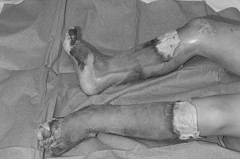 Fig. 8Day 7 post-burn. Aquacel Ag� still adhering to both legs.