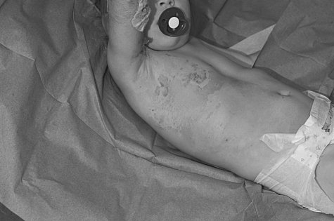 Fig. 9Day 7 post-burn. Aquacel Ag� detaches from right chest, with wound healing nicely.