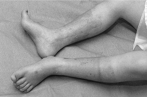 Fig. 11Four weeks post-burn. Lesions almost completely healed