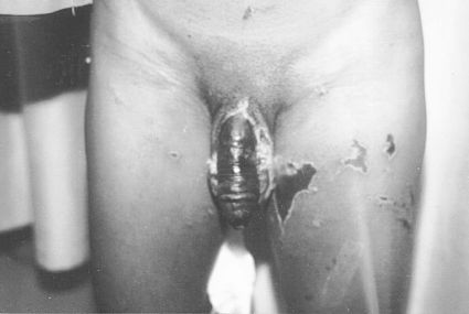 Fig. 1Patient with accidental chemical burn to the penis, scrotum, and medial aspect of left thigh. There are demarcated necrotic areas in the burn region.