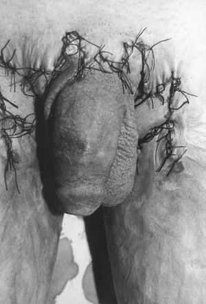 Fig. 2bAfter release of contractures with multiple Z-plasties.