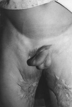 Fig. 3aChild with contracture of prepuce to the thigh one year after chemical burn.