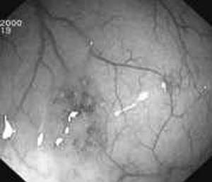Table I Ulcerative colitis relapses