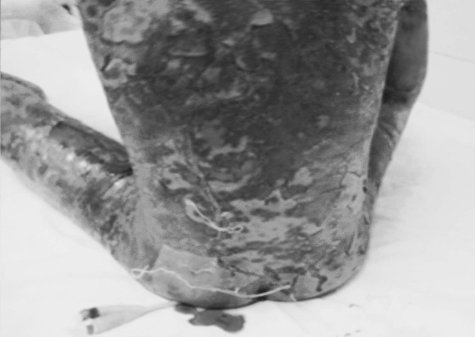 Fig. 1Severe exfoliation of skin of back, buttocks, and thighs.