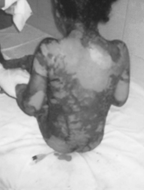 Fig. 2Back, buttocks, and thighs after removal of second dressing (10 days after admission when healing started).
