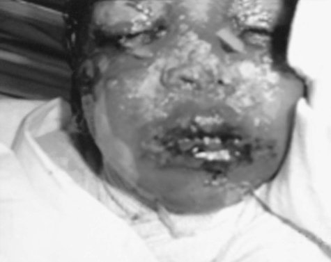 Fig. 3Severe exfoliation of face with involvement of skin, eyes, nose, and oral mucosa.