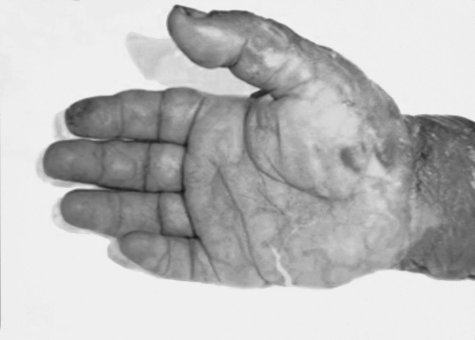 Fig. 4aBullous eruption of palm and skin exfoliation.