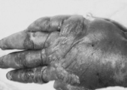 Fig. 4bExtensive eruption on dorsum of hand.