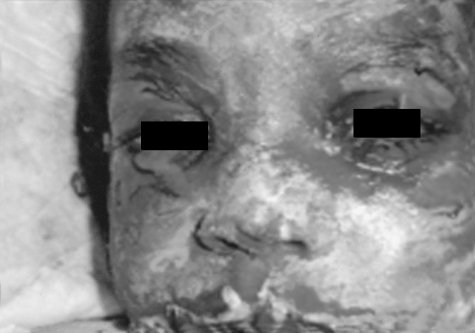Fig. 5Examination by ophthalmologist leads to peeling of the skin (Nikolsky�s sign).