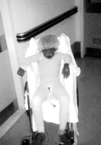 Fig. 6Child after occlusive dressing.