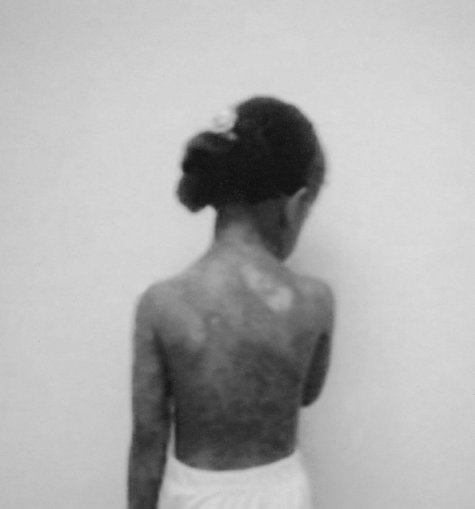 Fig. 7Complete healing with hypopigmented patches.