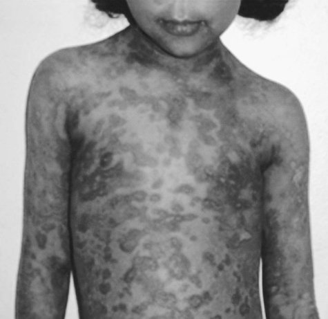 Fig. 8Skin healing with hyperpigmentation patches.
