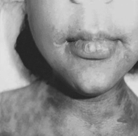 Fig. 9Healing of mucosa and skin hyperpigmentation.