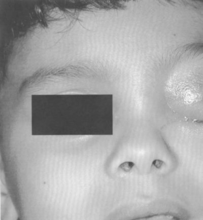 Fig. 1Br�lure de premier degr� de la paupi�re sup�rieure.