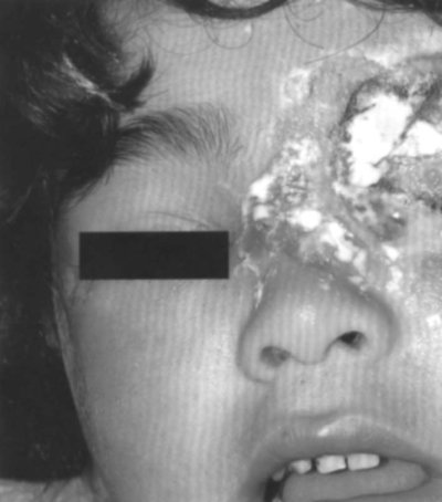 Fig. 2Br�lure de deuxi�me degr� du visage.