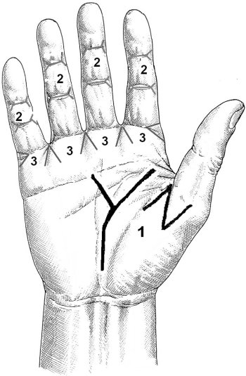 Fig. 2Timing of different steps in correction of hand contracture.<br>1.	Palmar and thumb area.<br>2.	Finger contractures.<br>3.	Web spaces.