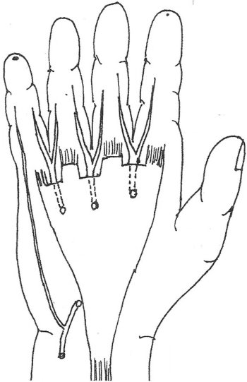 Fig. 3Scheme of blood supply to 5th finger.<br>1.	Digital arteries originating from palmar arch and running under the palmar aponeurosis.<br>2.	Lateral digital artery to 5th finger with extra-aponeurotic course.