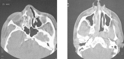 Fig. 2Epaississement de la muqueuse du sinus frontal droit.