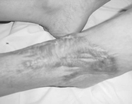 Photo 1Cicatrice hypertrophique du cou du pied.