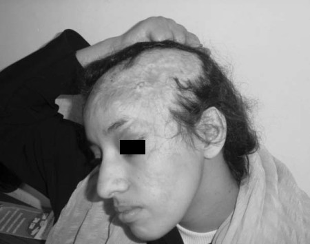 Photo 2Alop�cie cicatricielle chez une jeune femme..