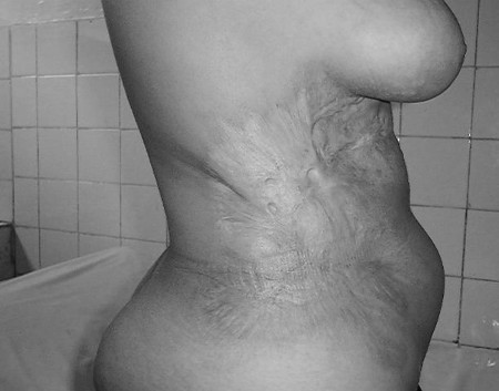 Photo 6Placard r�tractile de l�abdomen.