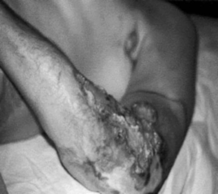 Photo 7aCarcinome spino-cellulaire sur s�quelle de br�lure.
