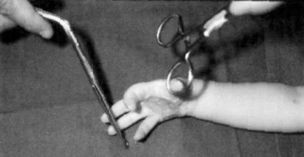 Fig. 1Escharectomy and grafting performed with incorrect splinting method, leading to hand contracture.