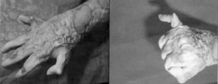 Fig. 2Deformities of a hand left to heal conservatively.