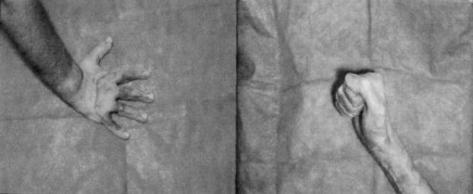 Fig. 3Hand of a patient in whom early escharectomy was performed.