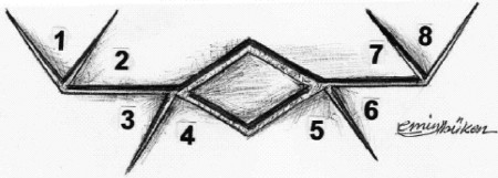 Fig. 4Appearance after release. Dotted areas show flap contraction