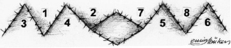 Fig. 5Triangular flaps sutured in their new locations