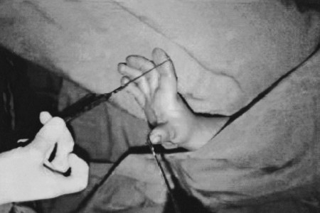 Fig. 6aPatient with first web space contracture