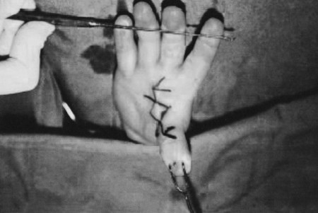Fig. 6bDrawing of rhomboid flap and Z-plasties on contracture band