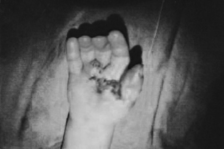 Fig. 6cImmediate post-operative view after contracture release