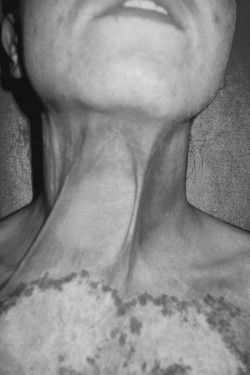 Fig. 7aPatient with neck contractures