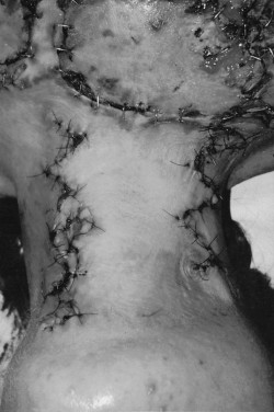 Fig. 7cPost-operative view on day 5 post-op