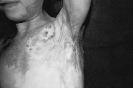 Fig. 8aPatient with left axillary contracture