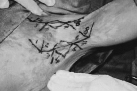 Fig. 8bPre-operative drawing of rhomboid flap and Z-plasties on contracture bands