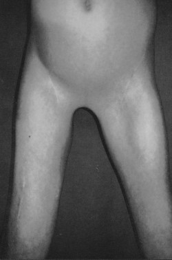Fig. 9aPatient with congenital pubic web